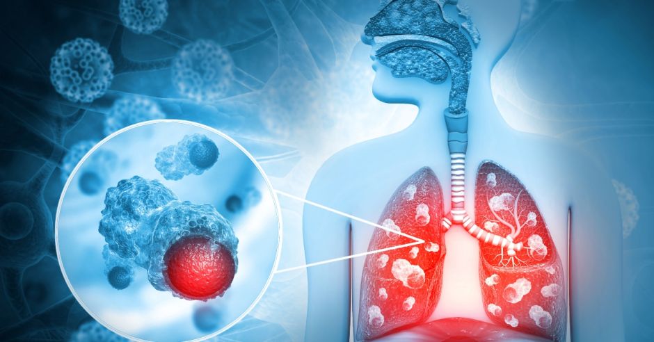 Medicina de precisión revoluciona el abordaje del cáncer más mortal del mundo, según experta de Pfizer
